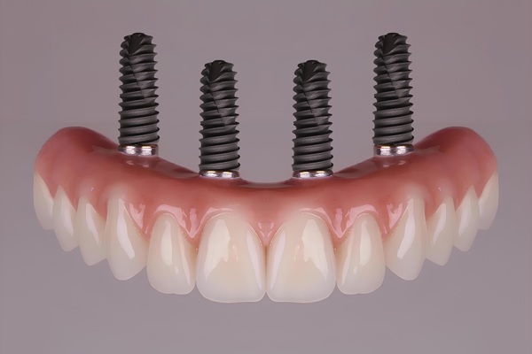 Replacing Upper Or Lower Set Of Teeth With All On